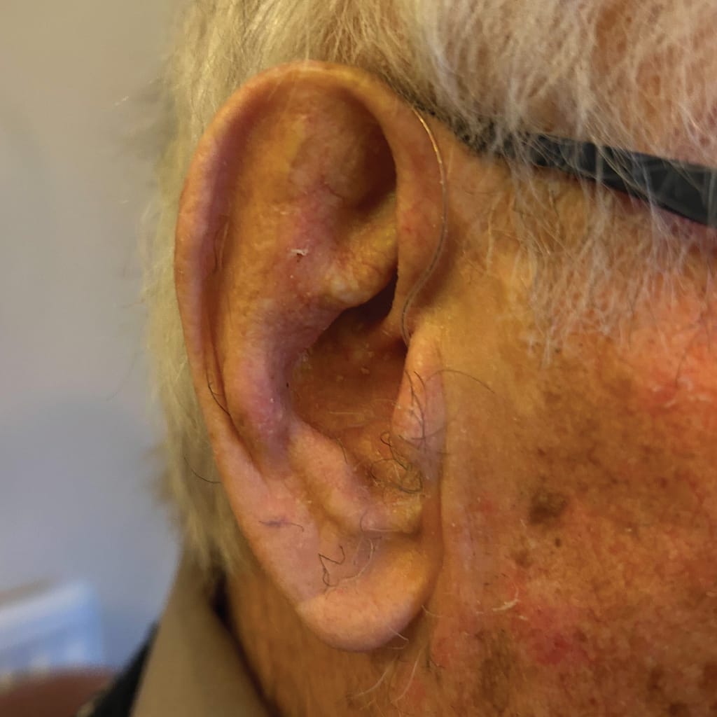 Mr. Dalton's ear- hearing aid not visible from this angle.